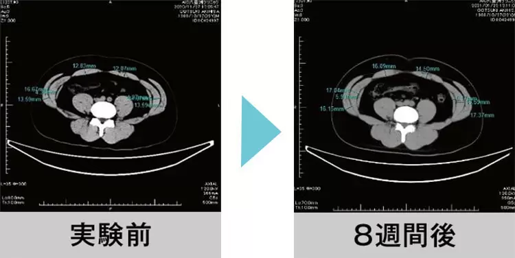 アクティブスレンダー 効果のMRI