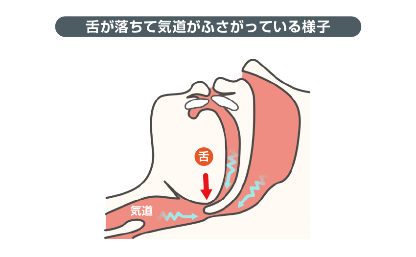 舌が落ちて気道がふさがっている様子