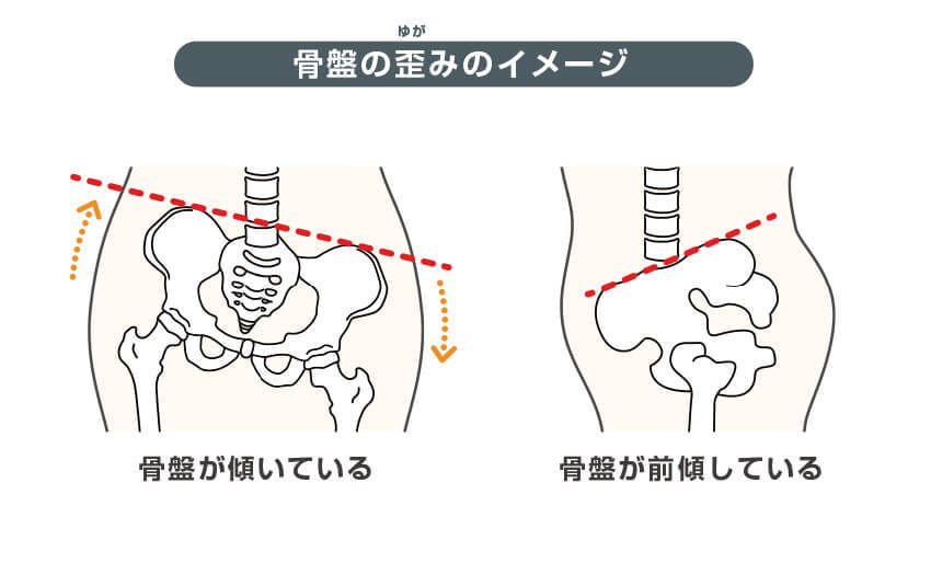 骨盤の歪みのイメージ