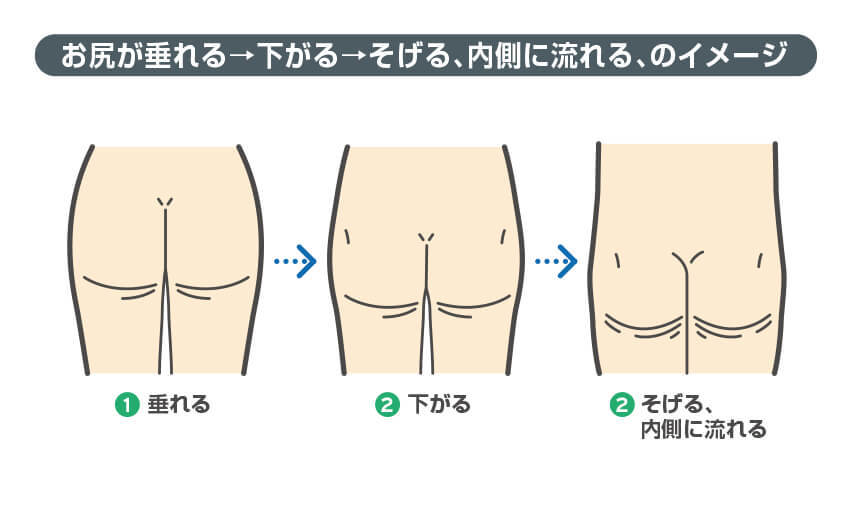 お尻が垂れる→下がる→そげる、内側に流れる、のイメージ