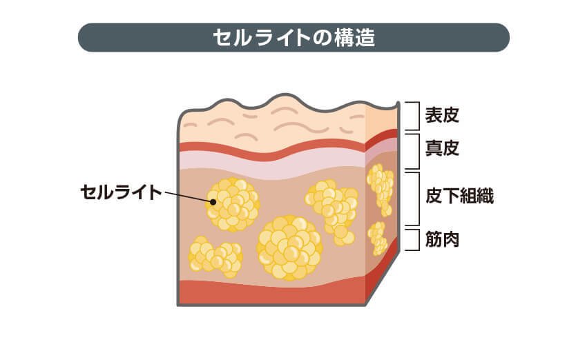 セルライトの構造