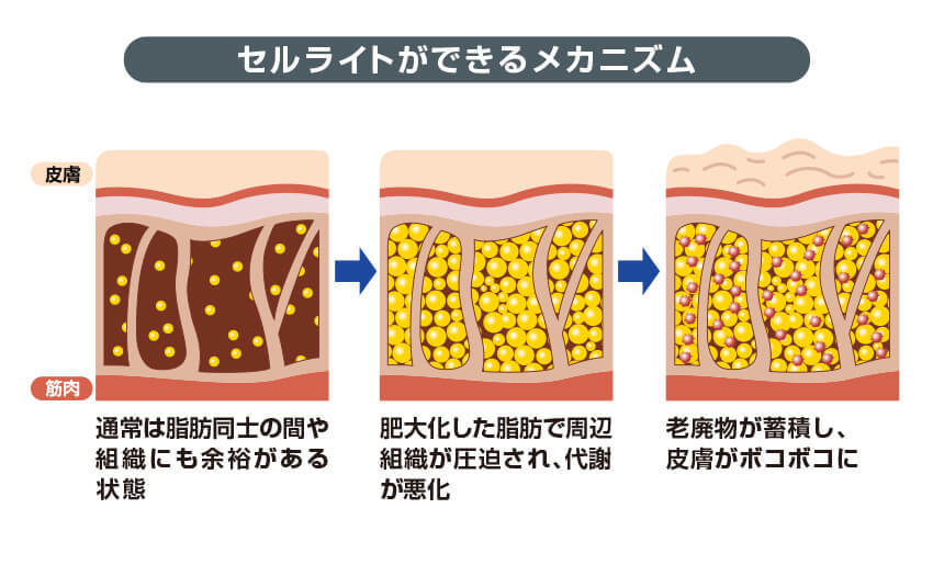 美容の敵セルライトの正体と予防法 Diet Labo ダイエットラボ ショップジャパン