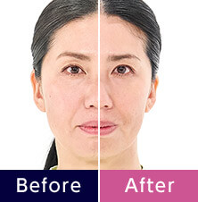 Before After