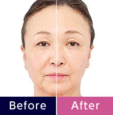Before After