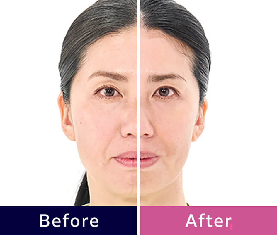 Before After