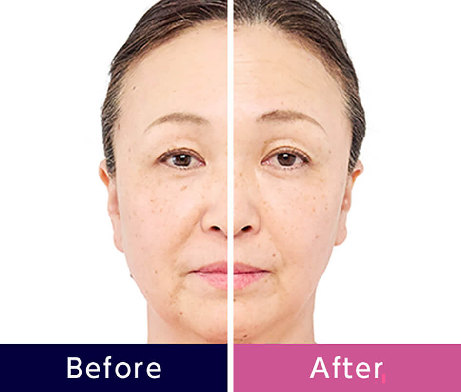 Before After
