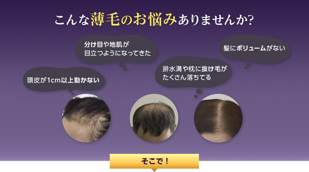こんな薄毛のお悩みありませんか？ 頭皮が1cm以上動かない 分け目や地肌が目立つようになってきた 排水溝や枕に抜け毛がたくさん落ちてる 髪にボリュームがない そこで！